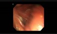 Endoskopische submuköse Dissektion (ESD) in der Therapie des submukösen Magenkarzinoms
