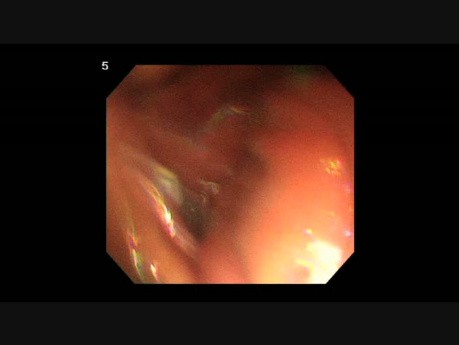 Endoskopische submuköse Dissektion (ESD) in der Therapie des submukösen Magenkarzinoms