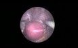 SELS: totale laparoskopische Hysterektomie in der Single-Port-Technik (8,5mm)
