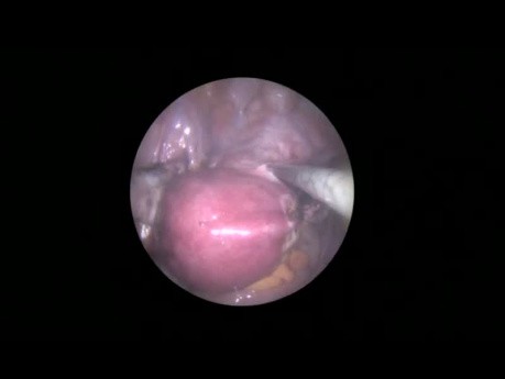 SELS: totale laparoskopische Hysterektomie in der Single-Port-Technik (8,5mm)