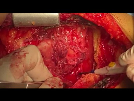 Patient mit konstriktiver Perikarditis und malignem Mesotheliom wurde einer CABG und Perikardiektomie unterzogen