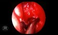 Routine-FESS (funktionelle endoskopische Nasennebenhöhlenchirurgie)