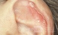 Psoriasis der Ohrmuschel