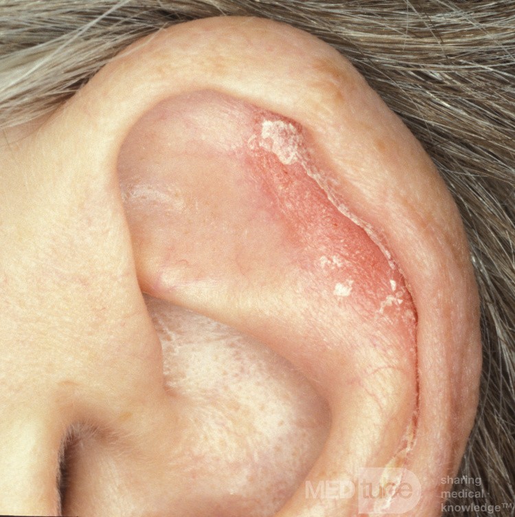 Psoriasis der Ohrmuschel