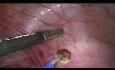 Endometriose