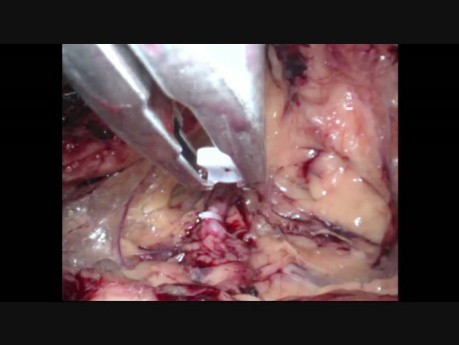 Laparo-Endoscopic Single-Site-Chirurgie (LESS)