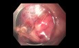 Hyperplastischer Magenpolyp