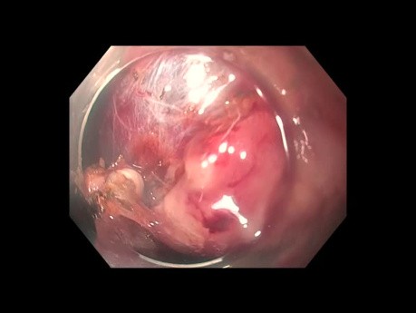 Hyperplastischer Magenpolyp