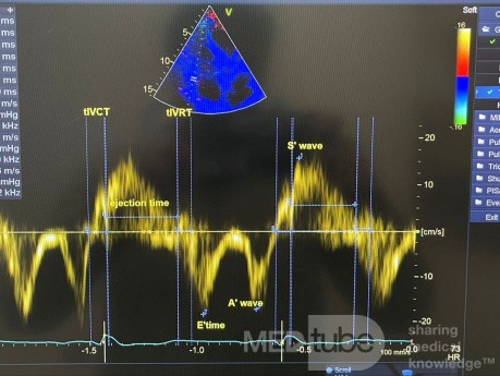 Bewertung der rechtsventrikulären diastolischen Funktion mittels Gewebedoppler und Tei-Index