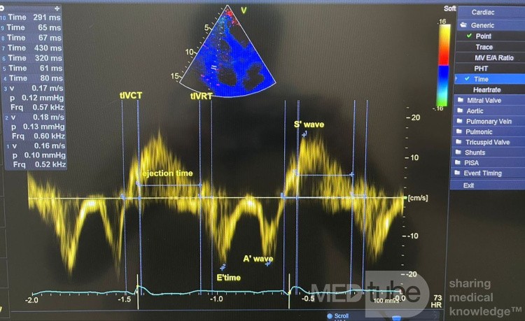 Bewertung der rechtsventrikulären diastolischen Funktion mittels Gewebedoppler und Tei-Index