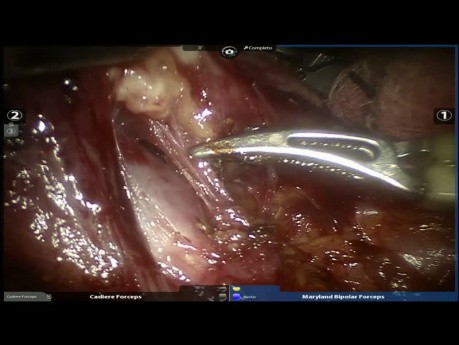 Roboterassistierte anatomische Segmentektomie