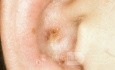 Herpes Zoster der Ohrmuschel
