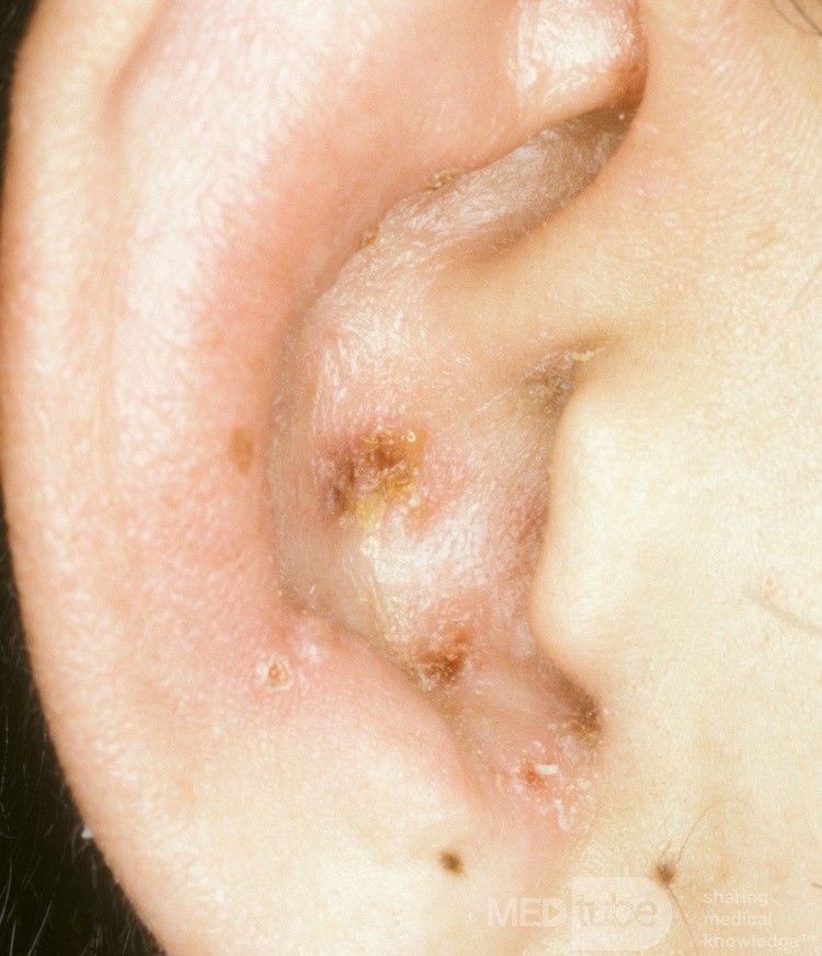 Herpes Zoster der Ohrmuschel