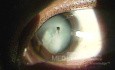 Fremdkörper in der Augenlinse