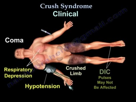 Crush-Syndrom 