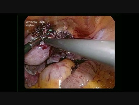 Laparoskopische Chirurgie der rechten Hornhautschwangerschaft