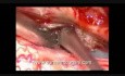 Rückenmarkstumor – spinales intradurales Meningeom – mikrochirurgische Exzision