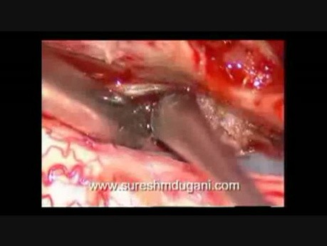 Rückenmarkstumor – spinales intradurales Meningeom – mikrochirurgische Exzision