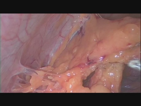 Totale laparoskopische Hysterektomie, bilaterale Salpingo-Oophorektomie, Peritoneallavage, Peritonealbiopsie