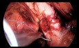 Präperitoneale laparoskopische laterale Reparation zur Behandlung von Beckenorganprolaps