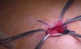 Fallstricke in der intragastrischen Chirurgie bei der Behandlung von Gastrointestinale Stromatumoren