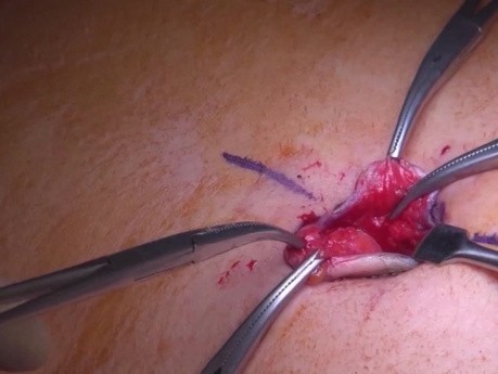 Fallstricke in der intragastrischen Chirurgie bei der Behandlung von Gastrointestinale Stromatumoren