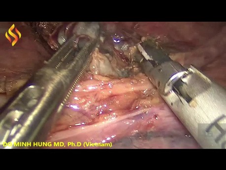 Thorako-Laparoskopische Ösophagektomie – Thorax Teil 5