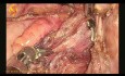 Tumor im retroperitonealen Bereich des Beckens