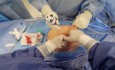 „Fail-Safe“-Technik für den ersten abdominalen Zugang bei laparoskopischer/robotischer Chirurgie („Streaming Hollow-Entry“)