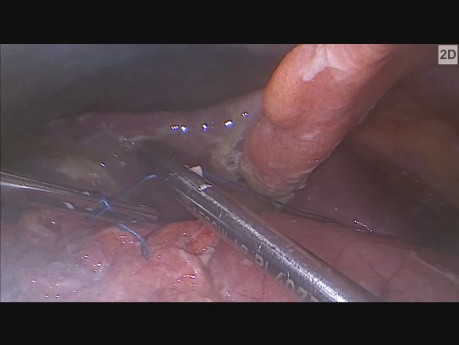Laparoskopiche Behandlung von perforierten Pylorusgeschwür