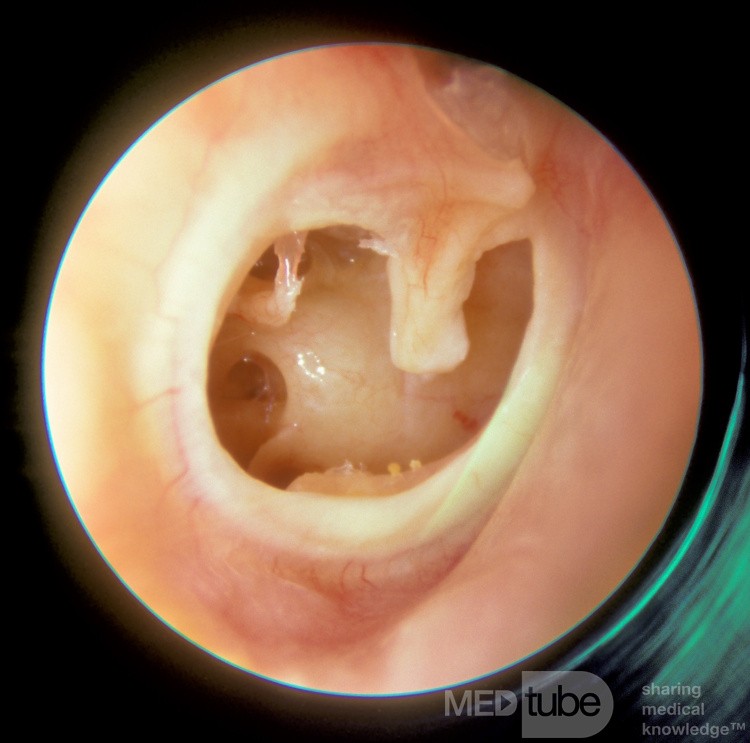 Subtotale Perforation des rechten Ohrs