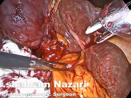 Laparoskopische Exploration des Ductus choledochus nach erfolgloser Steinextraktion mit ERCP