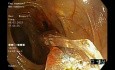Ballondilatation der Stenose