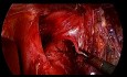 Totale laparoskopische Gastrektomie bei Magenkrebs