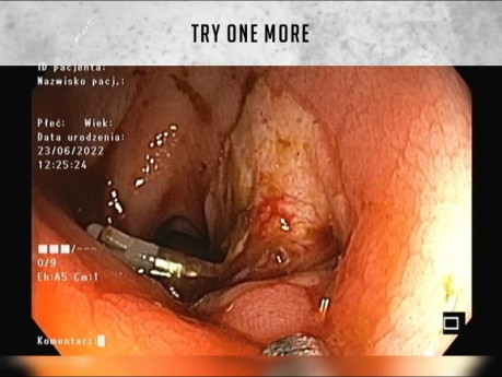 Gefäß im Resektionsbett nach endoskopischer submukosaler Dissektion (ESD) im Vergleich zu traditionellen Clips