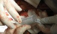 Chirurgie für thorakoabdominales Aortenaneurysma
