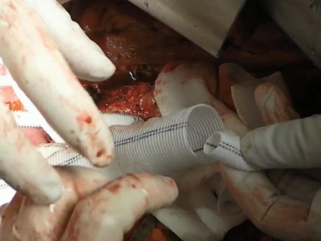 Chirurgie für thorakoabdominales Aortenaneurysma