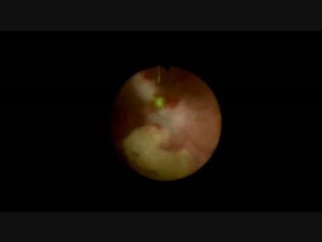 RIRS (Retrograde Intrarenal Surgery)