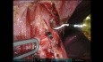 Robotisch assistierte Heller-Myotomie