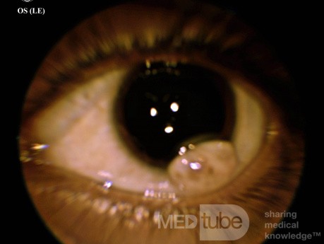 Limbales Dermoid