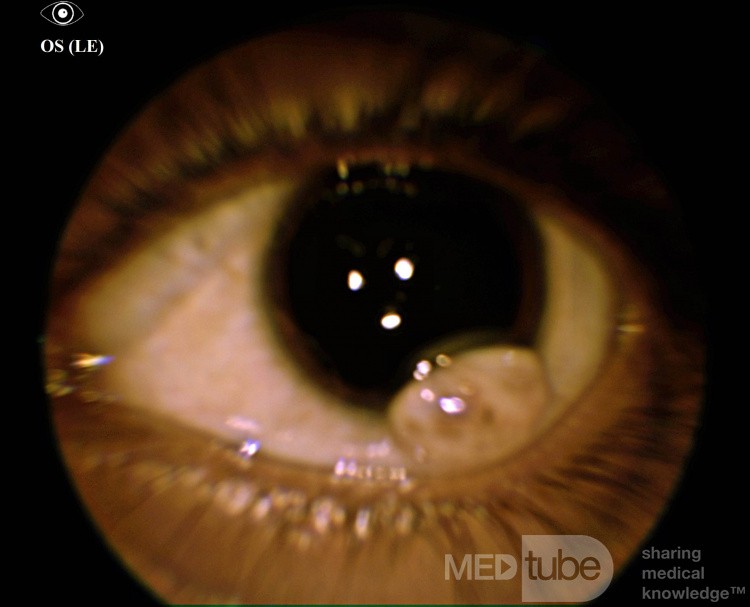 Limbales Dermoid