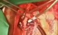 Operative Entfernung eines katheterassoziierten Thrombus aus dem rechten Vorhof