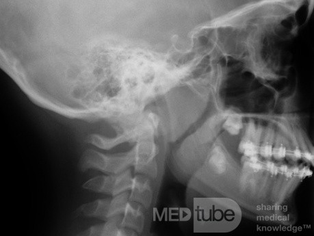 Laterales Röntgenbild eines Patienten mit vergrößerten Tonsillen und Adenoiden