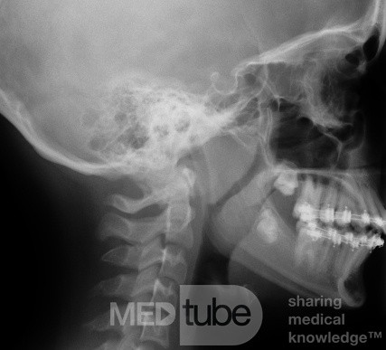 Laterales Röntgenbild eines Patienten mit vergrößerten Tonsillen und Adenoiden