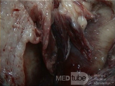 Uterines Karzinosarkom 