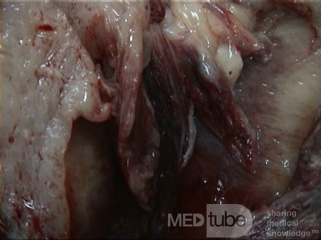 Uterines Karzinosarkom 