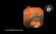  Endoskopische Mukosaresektion (EMR) bei der Behandlung von großen Rektumpolypen