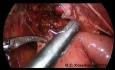 Laparoskopische Hepatojejunostomie