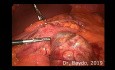 Laparoskopische Magenteilentfernung bei GIST Tumor