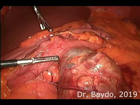Laparoskopische Magenteilentfernung bei GIST Tumor